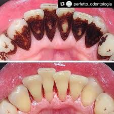 Pin De Paula Medina Em Dientes Saude Bucal Ortodontia Carie Dentaria