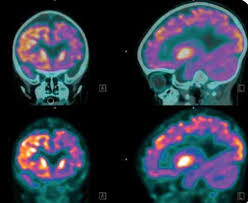 Check spelling or type a new query. Catheter Ablations Reduce Risks Of Stroke In Heart Patients With Stroke History Study Finds Eurekalert Science News