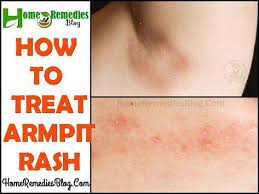 Home Remedies To Treat Armpit Rash Armpit Rash Underarm Rash Itchy Underarms