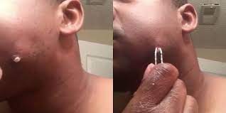 Below, the best ingrown hair treatments for smooth skin. This Ingrown Hair Video Is A Pimple Popping Dream