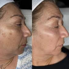 Discover your path to radiant skin with customized care! Our Platinum  Hydrafacial provides a deep cleanse and hydration for a luminous  complexion. #hydrafaci̇al #hydrafacials #oc #skincareroutine  #skincareproducts #skin #losangeles #clearskin ...