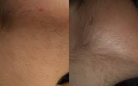 Como siempre hago, me gusta probar las cosas a fondo para poder emitir un juicio en condiciones. Venta Laser Vello Facial Opiniones En Stock