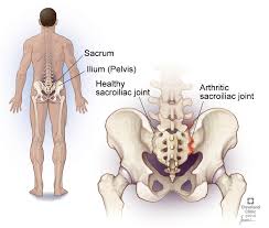 In this article, we'll discuss five causes of lower back and hip. Sacroiliitis Symptoms Causes Manangement Treatment