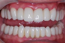 Check spelling or type a new query. Full Mouth Reconstruction In California Oc Dental Implants