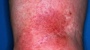 Image result for erysipel photos)