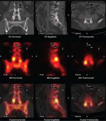 Spect Ct Scans How It Works What Spect Ct Identifies