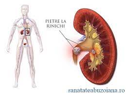 We did not find results for: Cum Scapam De Pietrele La Rinichi SÄƒnÄƒtatea BuzoianÄƒ