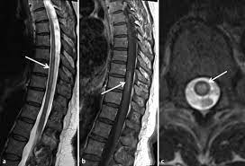 Transverse myelitis is an acute inflammatory disease of the spinal cord, characterized by rapid onset of bilateral neurological symptoms. Differenzialdiagnostik Der Myelitis Pdf Kostenfreier Download