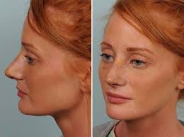 Vous avez déjà tous entendu ou utilisé cette expression qui désigne quelque chose de flagrant, de clairement visible. Rhinoplastie Ultrasonique Moins Traumatisante Pour Mon Nez Et Pour Moi L Express Styles