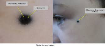 Image result for Blue Nevus