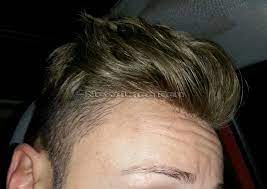 Risparmia con le migliori offerte per protesi capelli uomo a maggio 2022! Protesi Capelli Prezzi Off 60 Www Loverethymno Com