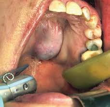 Check spelling or type a new query. Open Surgical Approaches To The Paranasal Sinuses Plastic Surgery Key