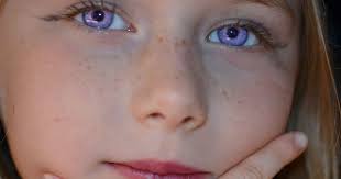 People With Purple Eyes Disease Images