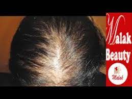الحل السحرى لعلاج مشكلة تراجع الشعر من الأمام علاج الشعر الخفيف المنحول عند مقدمة الرأس مع ملك youtube