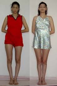 Operative Correction Of Bow Legs Knock Knees Bow Legged Correction Knock Knees Bow Legged