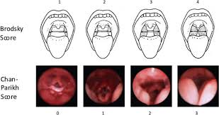 Comparison Of Brodsky Physical Exam Score And Representative