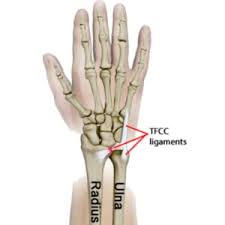 The tfcc helps stabilise the wrist joint and acts as a focal point for force transmitted across the tfcc surgery takes place under general anaesthesia. Amazon Com Wristwidget Tm Patented Adjustable Support Wrist Brace For Tfcc Tear Triangular Fibrocartilage Injuries Ulnar Sided Wrist Pain Weight Bearing Strain Left Or Right Hand Regular Black Health