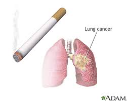 It may not be lung cancer, but if it is, an early diagnosis can make a huge difference. Lung Cancer Small Cell Information Mount Sinai New York