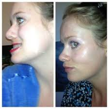 My Broken Face A Girl S Journey Through Double Jaw Surgery Double Jaw Surgery Jaw Surgery Corrective Jaw Surgery