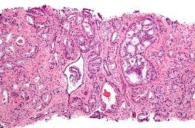 Symptoms of advanced prostate cancer symptoms of advanced prostate cancer include: Deadly Form Of Advanced Prostate Cancer Is Common Calls For Distinct Treatment Uc San Francisco