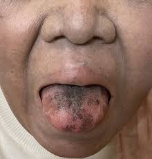 Image result for brown tongue symptoms