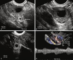 Image result for corpus luteum sonography)