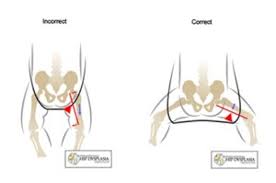 Gluteal Crease Newborn