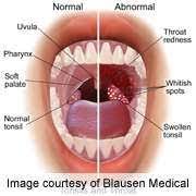 We did not find results for: Hpv Linked Throat Cancer May Have Telltale First Symptoms