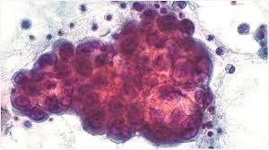 This process of infiltration to other sites is called metastasis. Lung Cancer And Electrolyte Imbalances