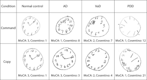 The total possible score is 30 points; Clock Drawing In The Montreal Cognitive Assessment Recommendations For Dementia Assessment Abstract Europe Pmc