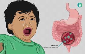 Rotavirus is a very contagious virus that causes diarrhea. Rotavirus Symptoms Causes Treatment Medicine Prevention Diagnosis