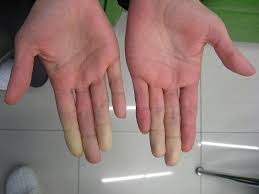 Difference Between Raynaud S Disease And Buerger S Disease Compare The Difference Between Similar Terms