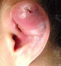 Infected Cartilage Piercings Causes Symptoms Treatment Authoritytattoo