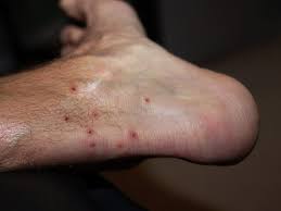 Image result for scabies human bites
