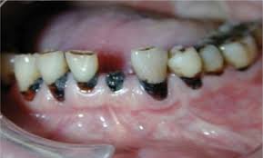 Image result for dental cancer