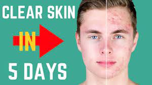 Depending on how well these products work with your skin it can take either 1 day, 2 days, a week, 2 weeks. How To Really Get Clear Skin In 5 Days Youtube