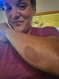 Best way to heal curling iron burn scars?