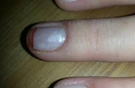 27 avril 2005 à 9h39 dernière réponse : Ongle Gel Tres Tres Casse Jusqu Au Sang Aie Que Faire Forum Manucure Nail Art Et Ongle