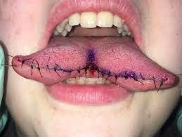 Nsfw Gore Freshly Stitched Up Tongue Split Procedure I Had Done Before The Pandemic Piercing