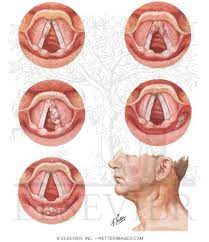 The throat, or pharynx, has many parts, and cancer can develop in most of them. Cancer Of The Larynx