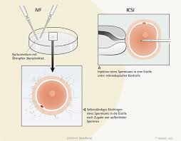 Wie effektiv ist die künstliche befruchtung zu hause? Behandlung Ivf Icsi Behandlung Bei Unerfulltem Kinderwunsch