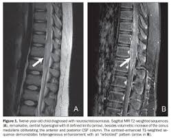 We did not find results for: Scielo Brasil Diagnostico Diferencial Das Lesoes Inflamatorias E Infecciosas Do Cone Medular Utilizando A Ressonancia Magnetica Diagnostico Diferencial Das Lesoes Inflamatorias E Infecciosas Do Cone Medular Utilizando A Ressonancia Magnetica
