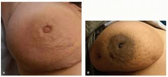 Instead, you may notice a rash that looks like an insect bite. Inflammatory Breast Cancer Oncohema Key