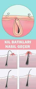 kil batiklari nasil gecer batik saglik dogal cilt