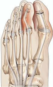 Includes an interactive tool to help you make your decision. Surgery For Problems Of The Small Toes Healthdirect