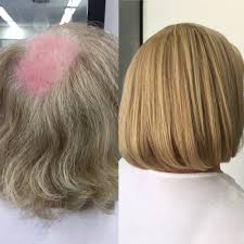 Hairpieces and extensions give similar results when it comes to length, volume, longevity, and realistic look. Real Wigs For Hair Loss Pasteurinstituteindia Com