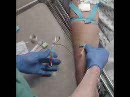 Insert the needle into the vein and once you have established blood. Drawing Blood With A Butterfly Needle Youtube