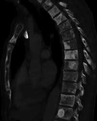 Prostate cancer is a common type of cancer in men, according to the mayo clinic. Prostate Cancer Wikiwand