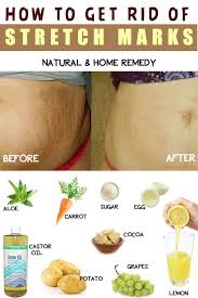 How To Get Rid Of Stretch Marks At Home Missingbeauty Com Stretch Marks Sugar Scrub Recipe Stretch Mark Remedies