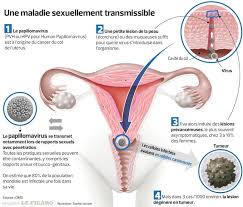 On observe chaque année 23 nouveaux cas de cancers du col de l'utérus pour 100 000 femmes. L Australie Sur Le Point D Eradiquer Le Cancer Du Col De L Uterus